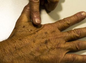 desinformacao-sobre-cancer-de-pele-afeta-diagnostico,-diz-instituicao